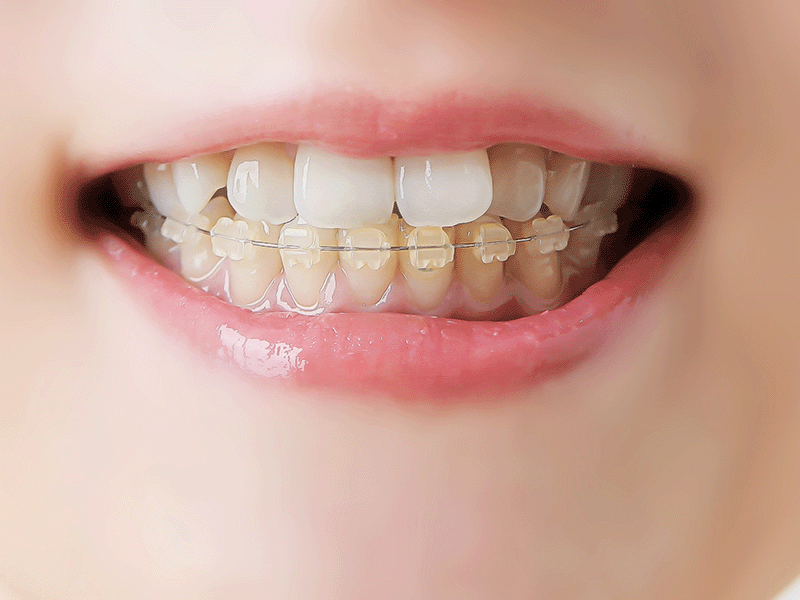 Ceramic Brackets