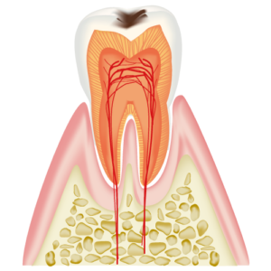 C1　Cavity within the Enamel
