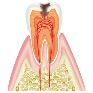 C2　Cavity Reaching the Dentin