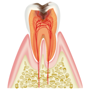 C3　Cavity Reaching the Dental Pulp (Nerve)