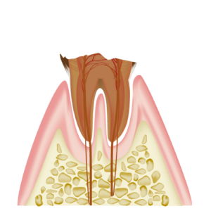 C4　Severely Decayed Tooth with Extensive Structure Loss