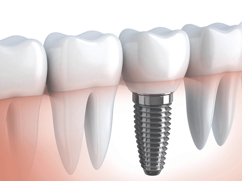 Implants