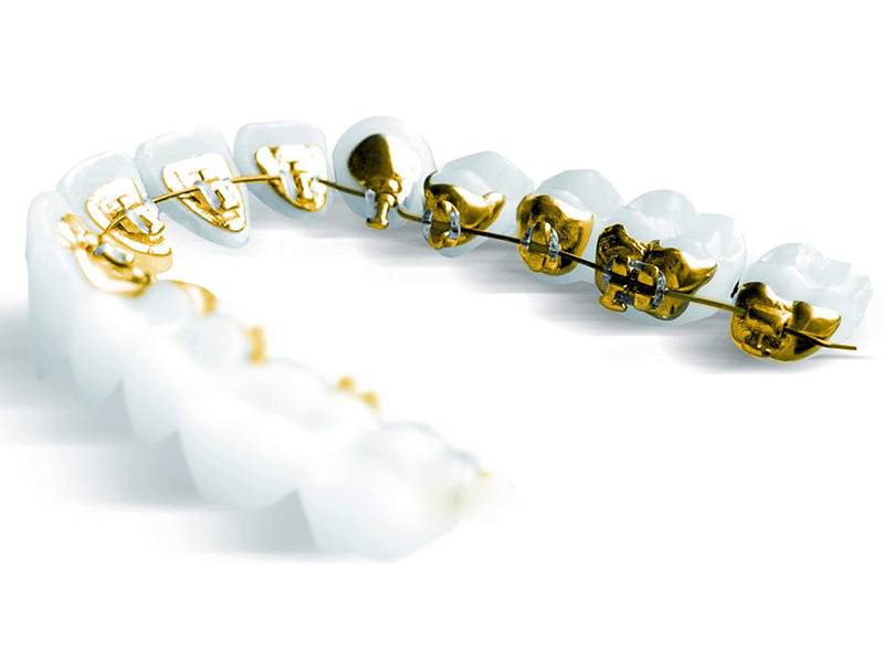 Lingual Braces (Incognito™ System)