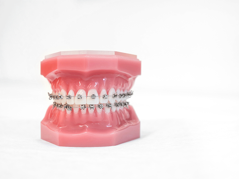 Metal Brackets