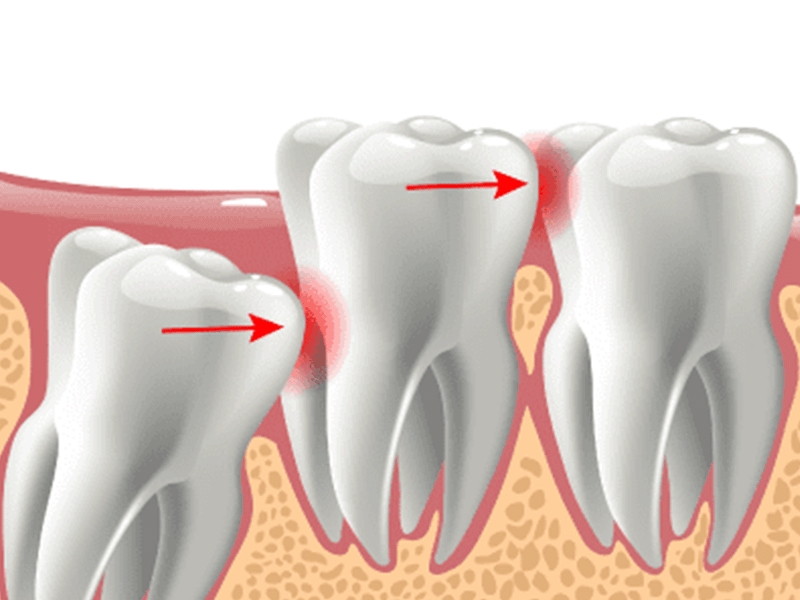 Wisdom Tooth