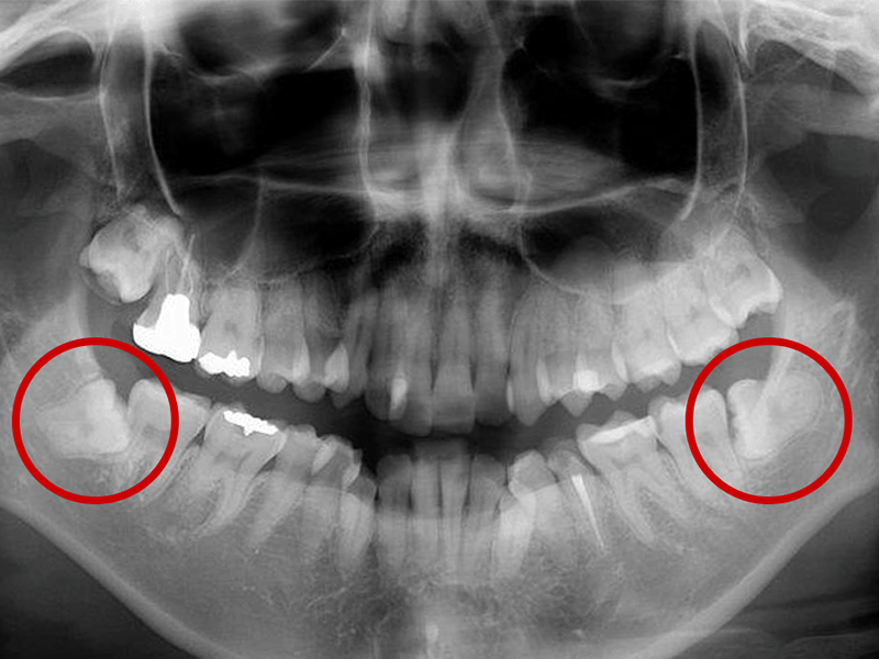Wisdom Teeth