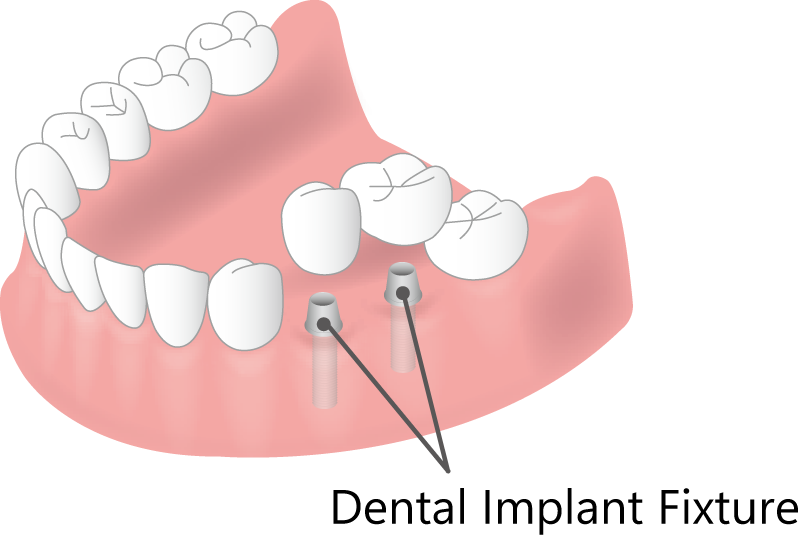 Dental implant fixture