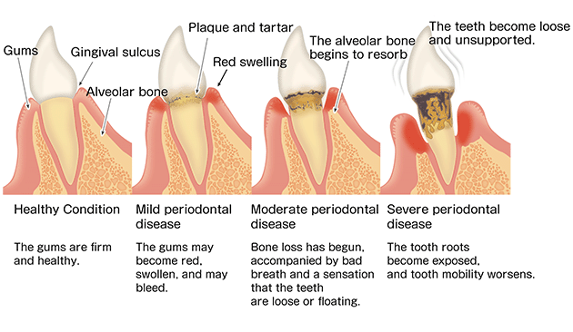 periodontal disease