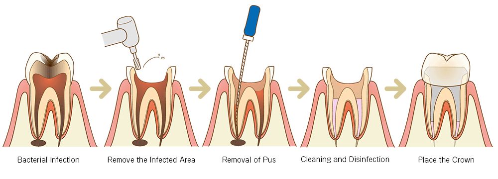 root-canal-step
